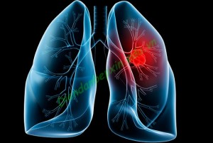 Phòng tránh ung thư phổi